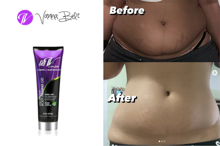 Stretch Mark Reduction