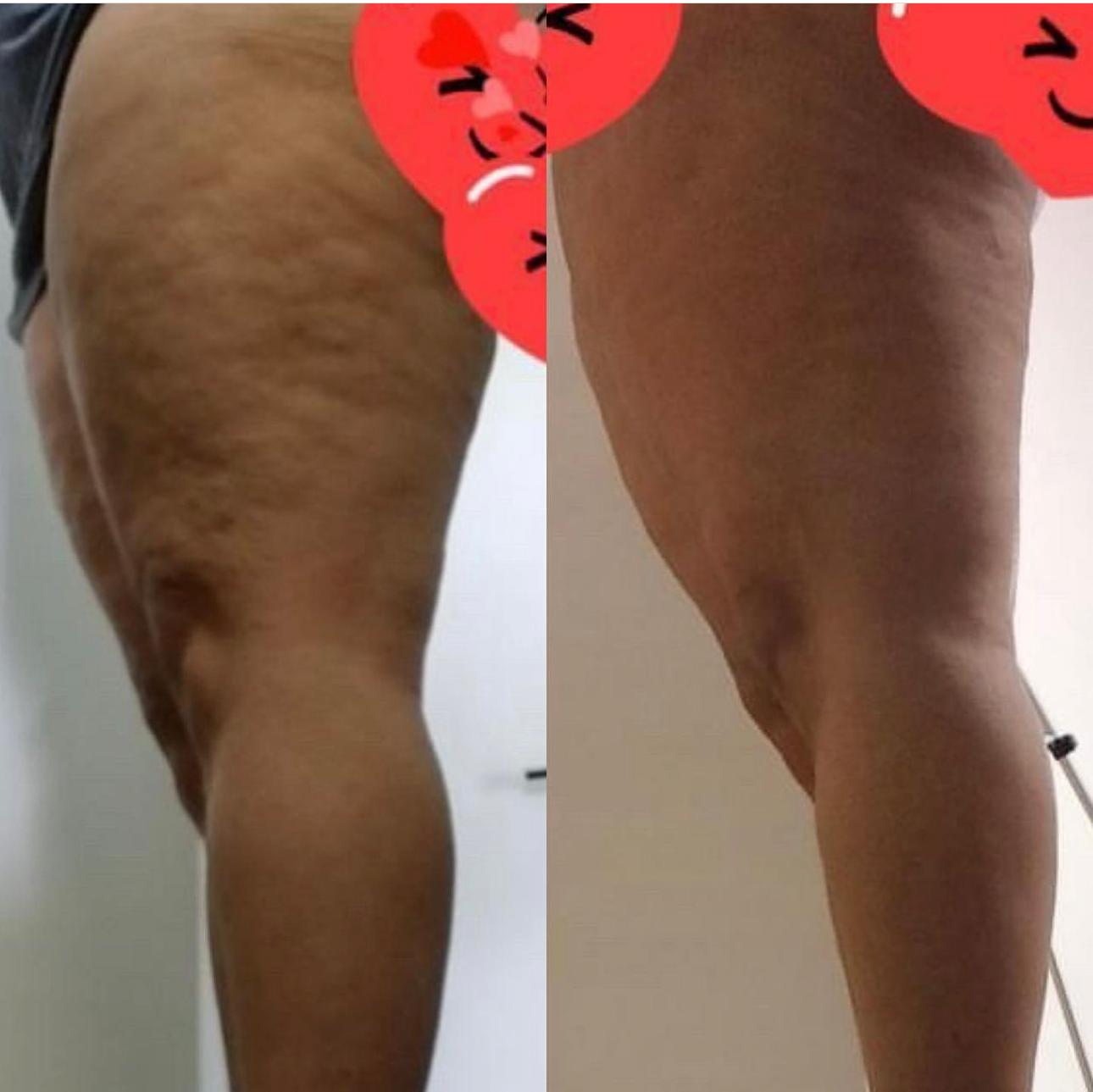 l carnitine cellulite reduction Now with Matcha Tea extract, Guaraná Extract and L-Carnitine. – VannaBeltGelv